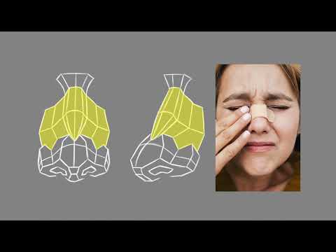 Why Your Nose Drawings Suck - Nose Drawing Course (1/8)