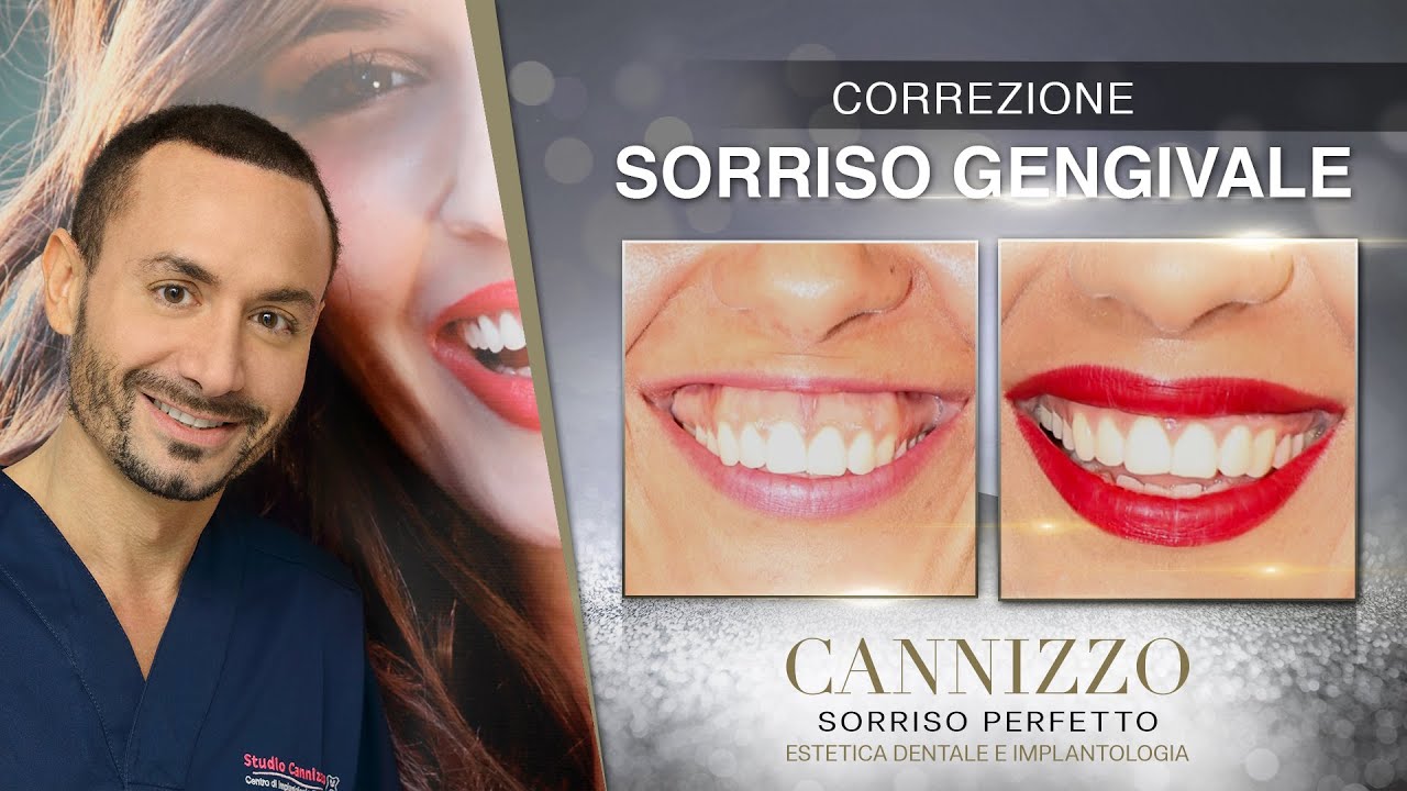 Correzione Sorriso Gengivale - Studio Cannizzo
