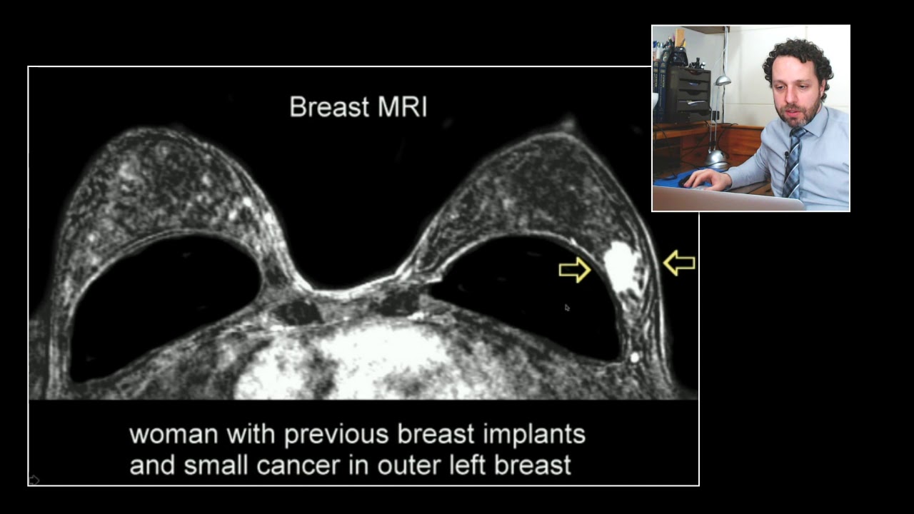 Câncer de mama: Rastreamento e procedimentos de diagnóstico?