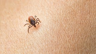 Watch the video - Medical Insight: Lyme Disease – Essentia Health