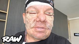 I Got Face Surgery in Turkey… First 72 Hours! 🇹🇷