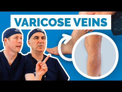 Varicose Veins Explained: Causes, Symptoms, and Treatments