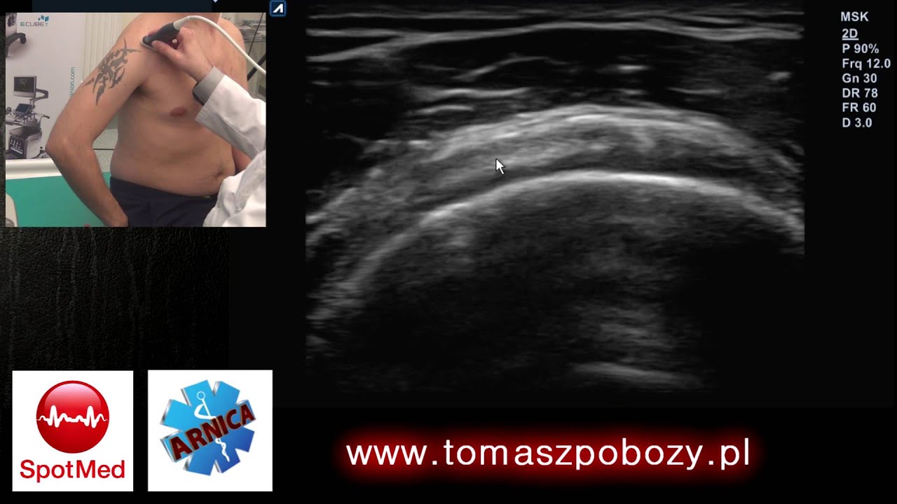 USG stawu ramiennego