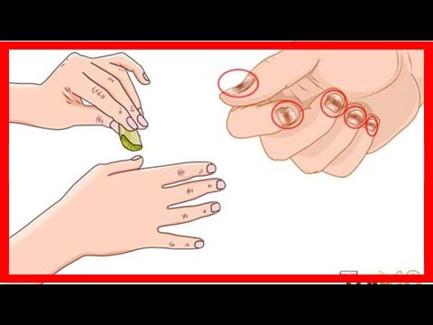 Emolenta in cura di dermatite atopic Erba che si riunisce per cura di psoriasi