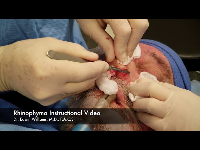 Video Pronunciation of rhinophyma in English