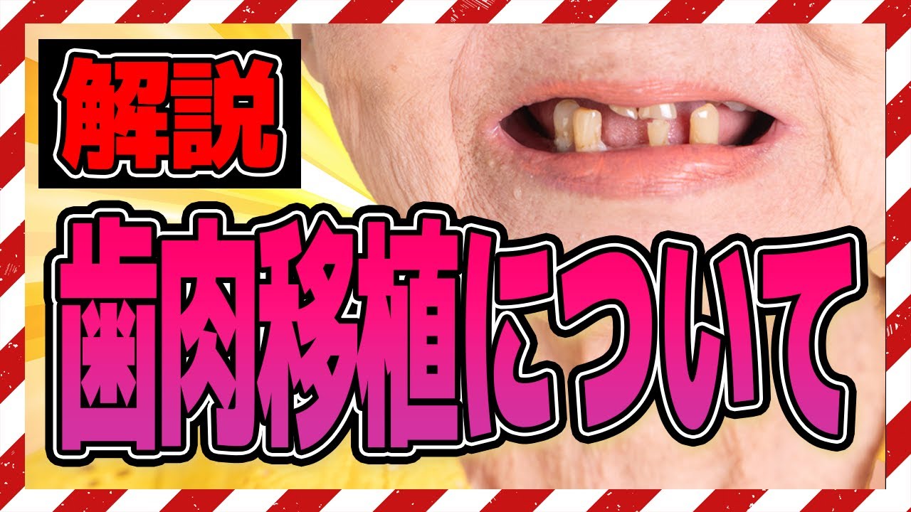 歯科治療で用いられる、歯肉の移植とは?
