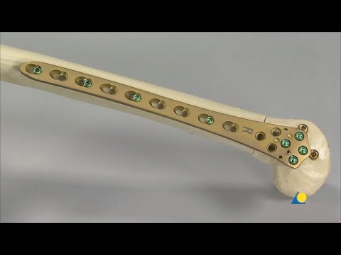 Femur, Distal - Intraarticular Fracture (33C2.1) - Fixation With the LCP Distal Femur Plate