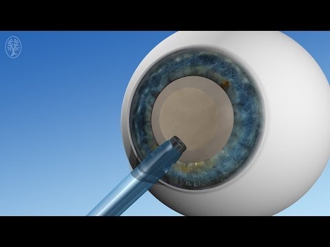 Cataract surgery (German version)