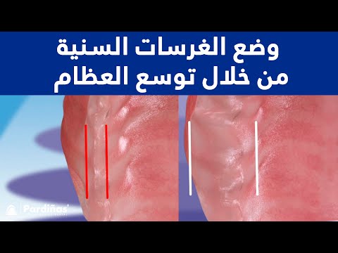 وضع الغرسات السنية من خلال توسع العظام ©
