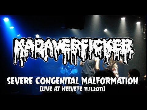 KADAVERFICKER - Severe Congenital Malformation (Live at Helvete 11.11.2017)