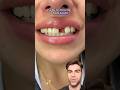 Missing Tooth Discover Instant Confidence Magic