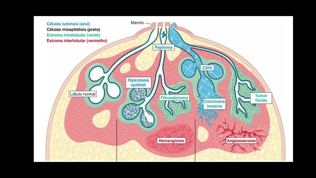 Laboratório de Habilidades - Patologia (doenças prevalentes mulher - CA mama) - parte 1