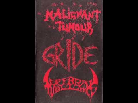 Malignant Tumour - Gride - Cerebral Turbulency - 3 Way Split Tape