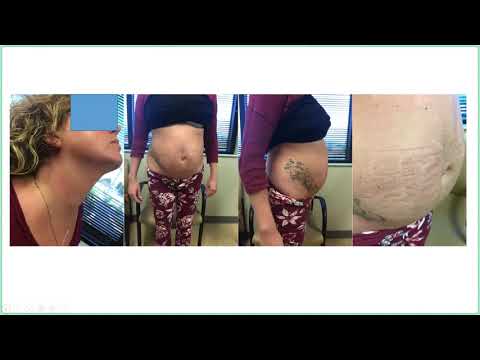 UofL Endocrinology Grand Rounds: Dr. Betty Villafuerte