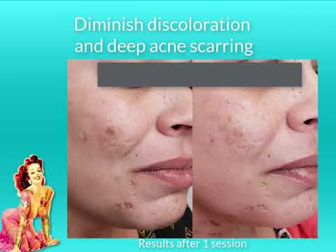 What is Microneedling? (Microchanneling)