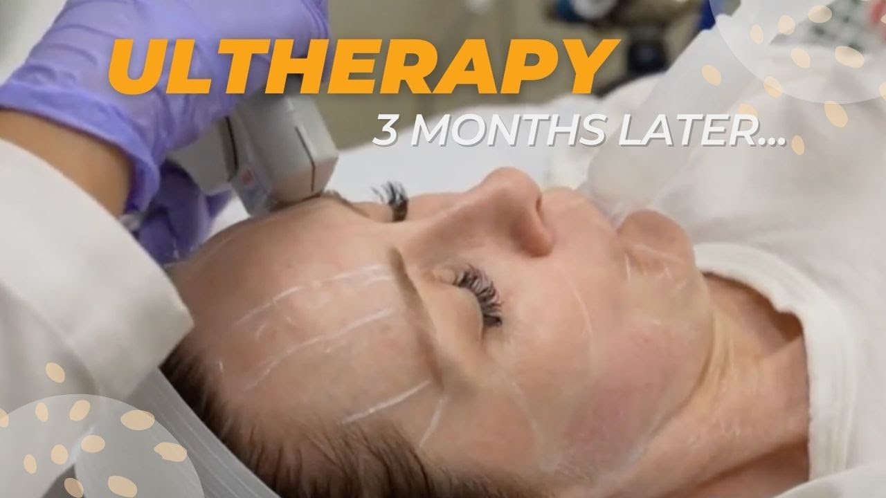 Corey Does Ultherapy: 3 Months Later