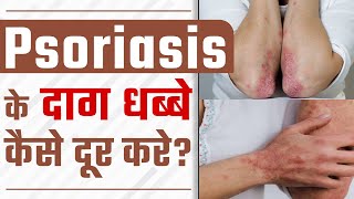 Psoriasis के दाग धब्बे कैसे दूर करे? | Tips to Cure Psoriasis Scars on Body | Dr Health