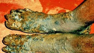 Best Jigger Removal - February 2017