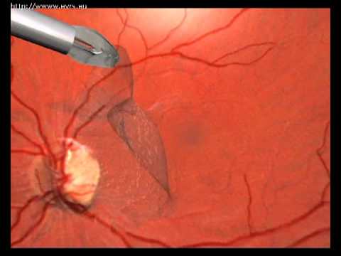 Sindromes Maculres - evrs