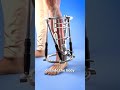 How To Stabilize A Broken Bone 🤔