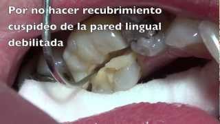 fractura dentaria