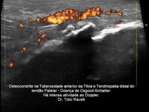 33 settimane di gravidanza fortemente mal di schiena Ginocchio trattare e tendine