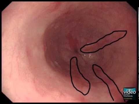 The Los Angeles Classification of Gastroesophageal Reflux Disease