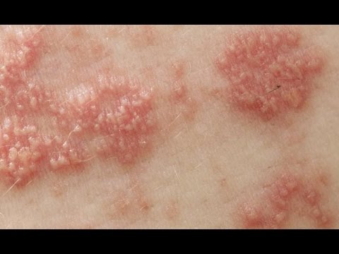 Del magnesio el sulfato de la psoriasis Artropatichesky la psoriasis el tratamiento público