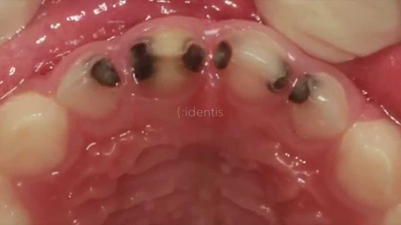 ¿Cómo detectar Caries en dientes de leche