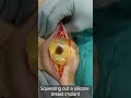 Squeeze Out Your Silicone Breast Implant Safely Removal Of Breast Implant Squeezing Out Silicone
