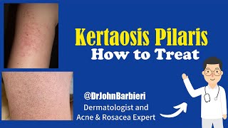 How to treat small pimple bumps on the arms – Dermatologist explains keratosis pilaris