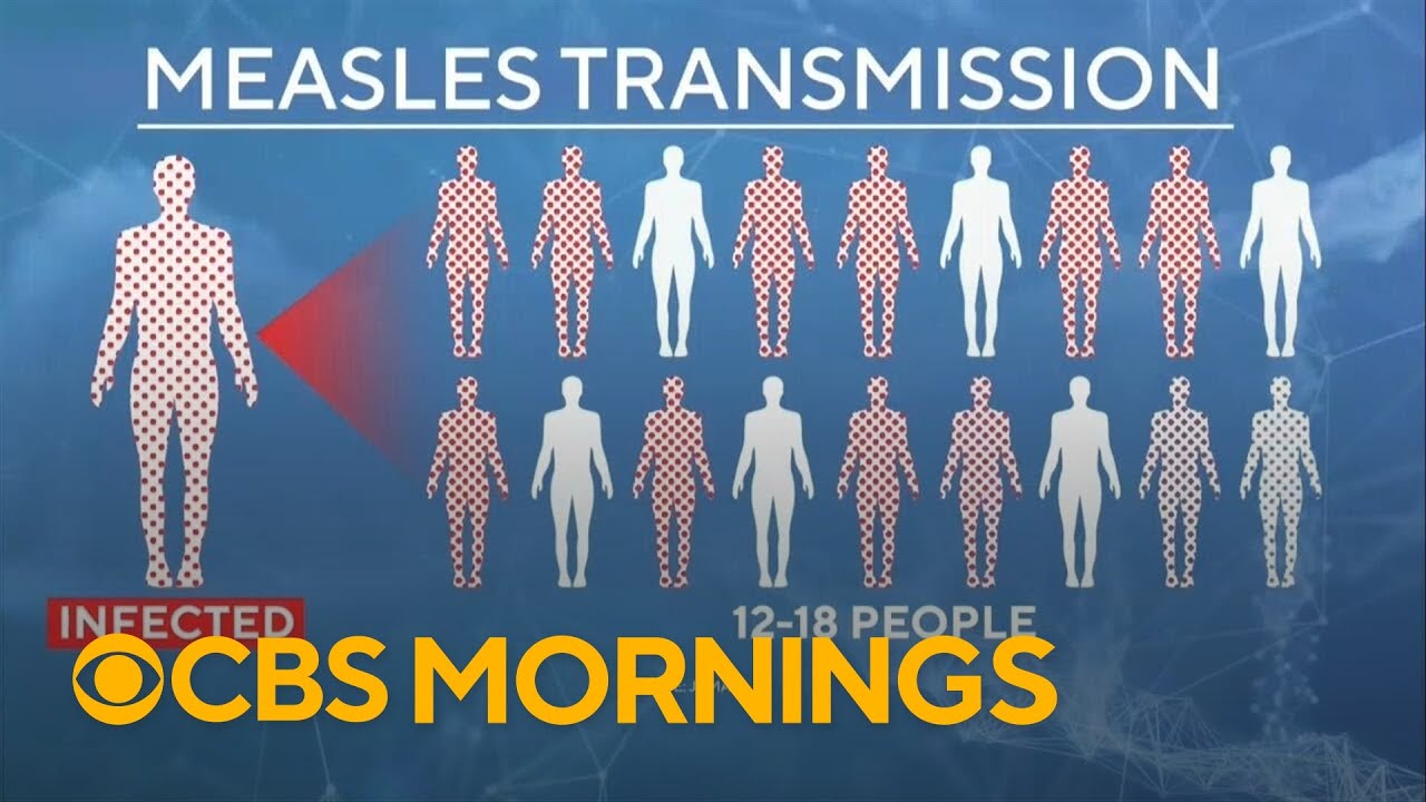 Measles cases climb in the U.S. after 2025 was worst year in decades