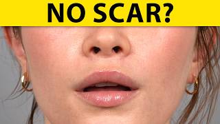 Is A SCARLESS LIP LIFT Possible?