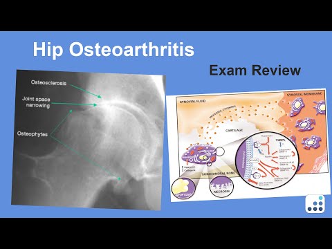 Hip Osteoarthritis Exam Review - William Jiranek, MD