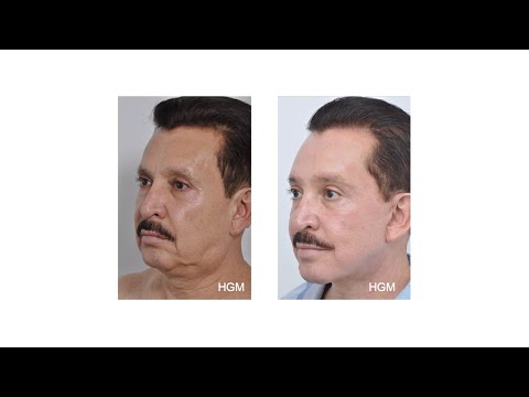 Learn from Dr.Hector G. Miramontes, master of the SMAS facelift, using deep plane approach