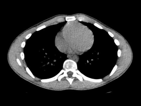 Chest CT scan — severe symmetric pectus carinatum