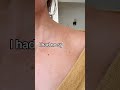 A swollen lymph node. Something so small I almost ignored it—until it led to my cancer diagnosis.