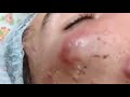 Big Acne, Pus on face pop out      Really hurt and terrified!!