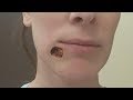 Giant blackhead removed, turns into gaping hole - Blackhead removal - How to remove blackhead