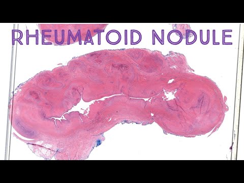 Rheumatoid Nodule - Palisaded Necrobiotic Granuloma in Rheumatoid Arthritis (Emory case 1)