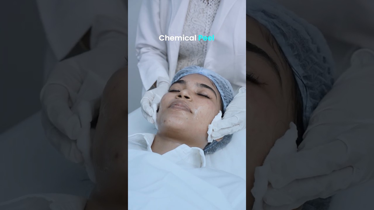 Chemical Peel for Acne Scars and Dark Spots-Peel to perfection #chemicalpeel #skincare