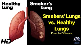 Smokers vs. Non-Smokers: A Lung Comparison You Need to See