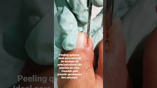 Download lagu tratamento peeling químico para onicofose /   Nilza Garcia Podóloga #podologia mp3 Download lagu tratamento peeling químico para onicofose /   Nilza Garcia Podóloga #podologia mp3