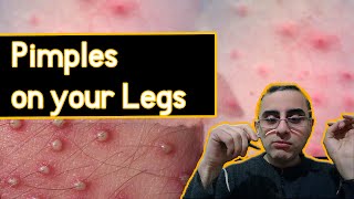 Pimples on The  legs - Funiculitis: Causes, treatment, prevention