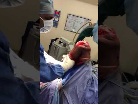 Open Fracture Patella(Bomb Blast) — Patient Video