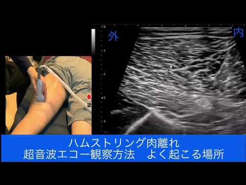 【基本編】ハムストリング肉離れ　超音波エコー観察方法