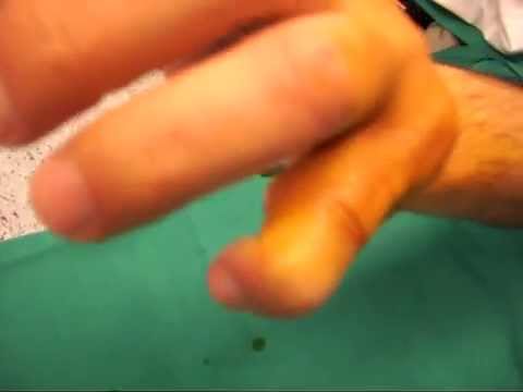 Osteoartrite del ginocchio disabilità 3 gradi Dove fa male con cervicale osteocondrosi foto