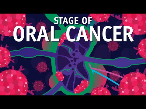 What is TNM Staging? How do We do Staging of Oral Cancer?