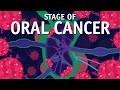 What Is TNM Staging How Do We Do Staging Of Oral Cancer