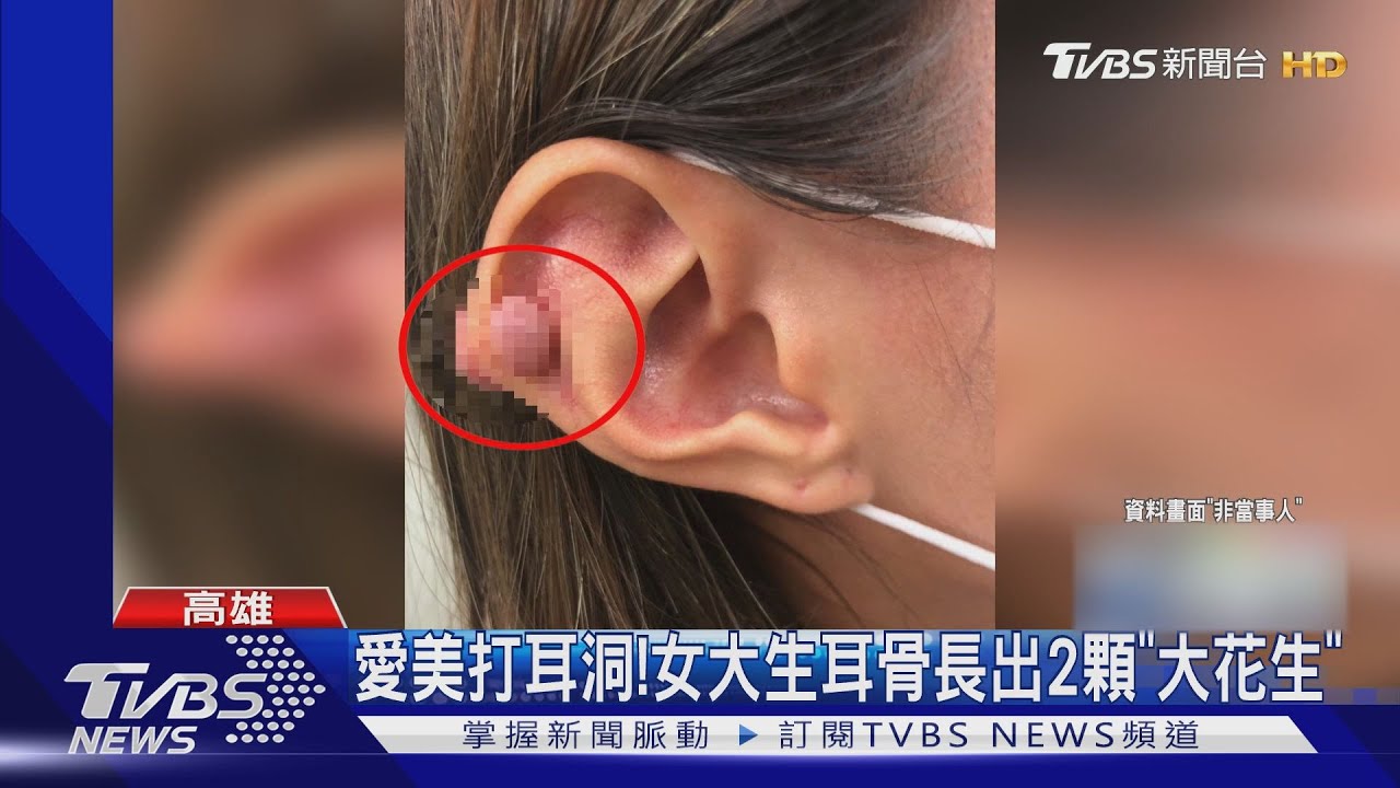 愛美打耳洞! 女大生耳骨竟長出2顆「大花生」